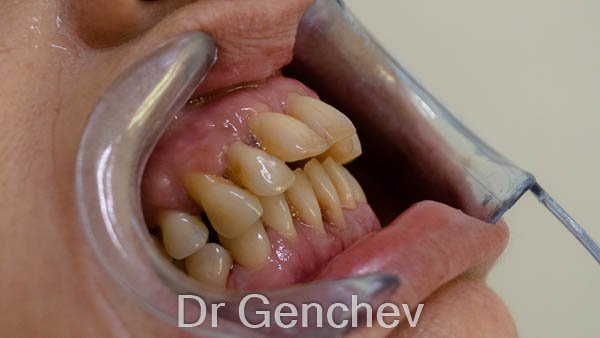 parodontite avant implant basal