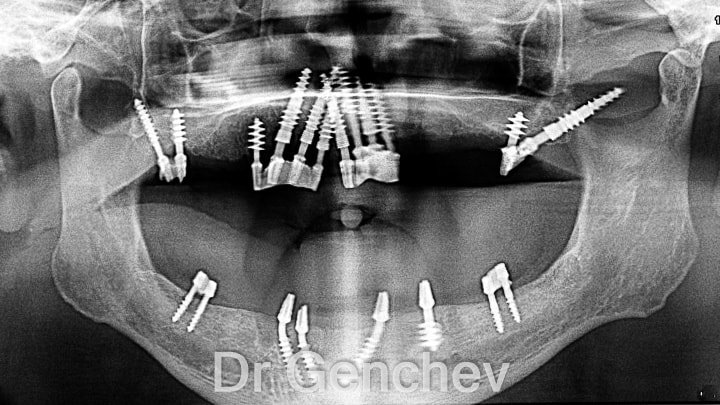 implant basal pour restauration dentaire complete 