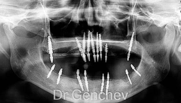 implants dentaires pterygoidiens