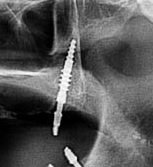 implant dentaire pterygoidien