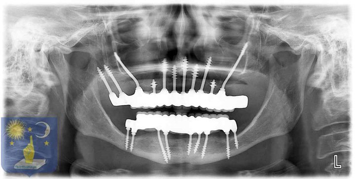 Implants dentaires zygomatiques