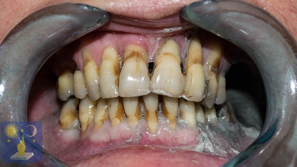 maladie parodontale sévère
