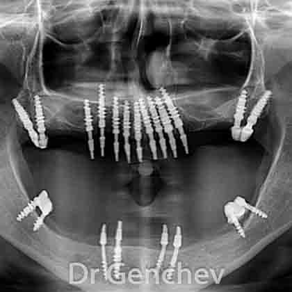 implant dentaire basal xray radio panoramique 