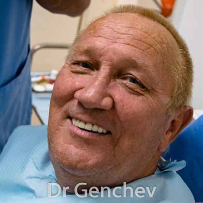 patient qui fait du bruxisme apres implant dentaire basal
