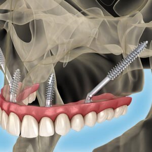 implant dentaire zygomatique