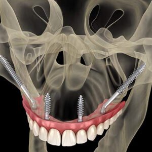 Implant dentaire pterygoidien