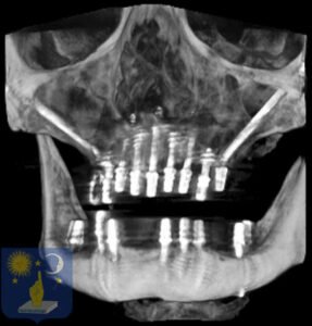 implant dentaire zygomatique