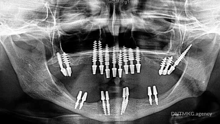 radio panoramique avec implant basal pour restauration des 2 machoires