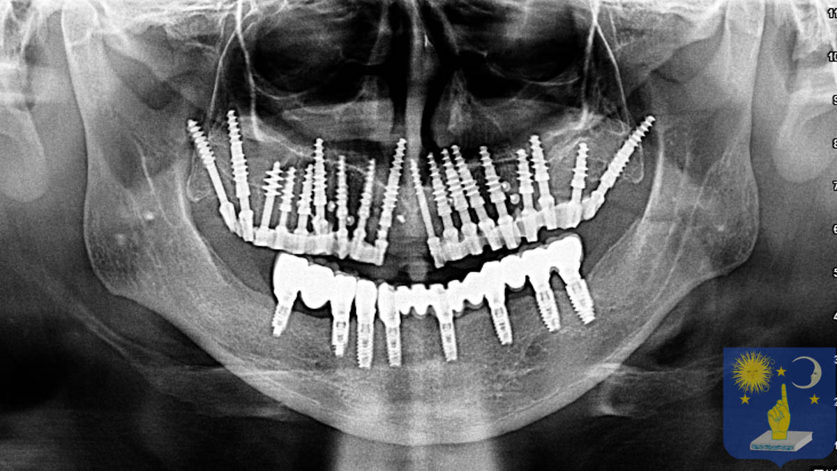 Dr Genchev implant basal pour édentation totale