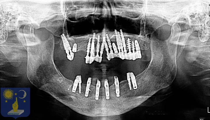 All-on-6 corrigé avec implant basal