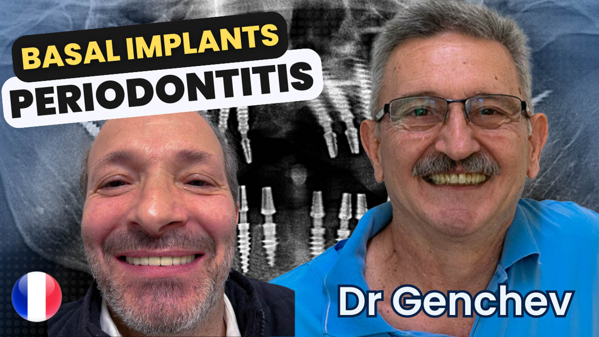 Implant basal pour parodontite – Dr Genchev