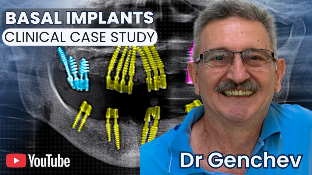 Vignette vidéo du Dr Genchev pour une étude de cas clinique sur l'implantologie basale